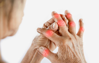 Rheumatoid Arthritis - Woman suffering from joint pain with gout in finger