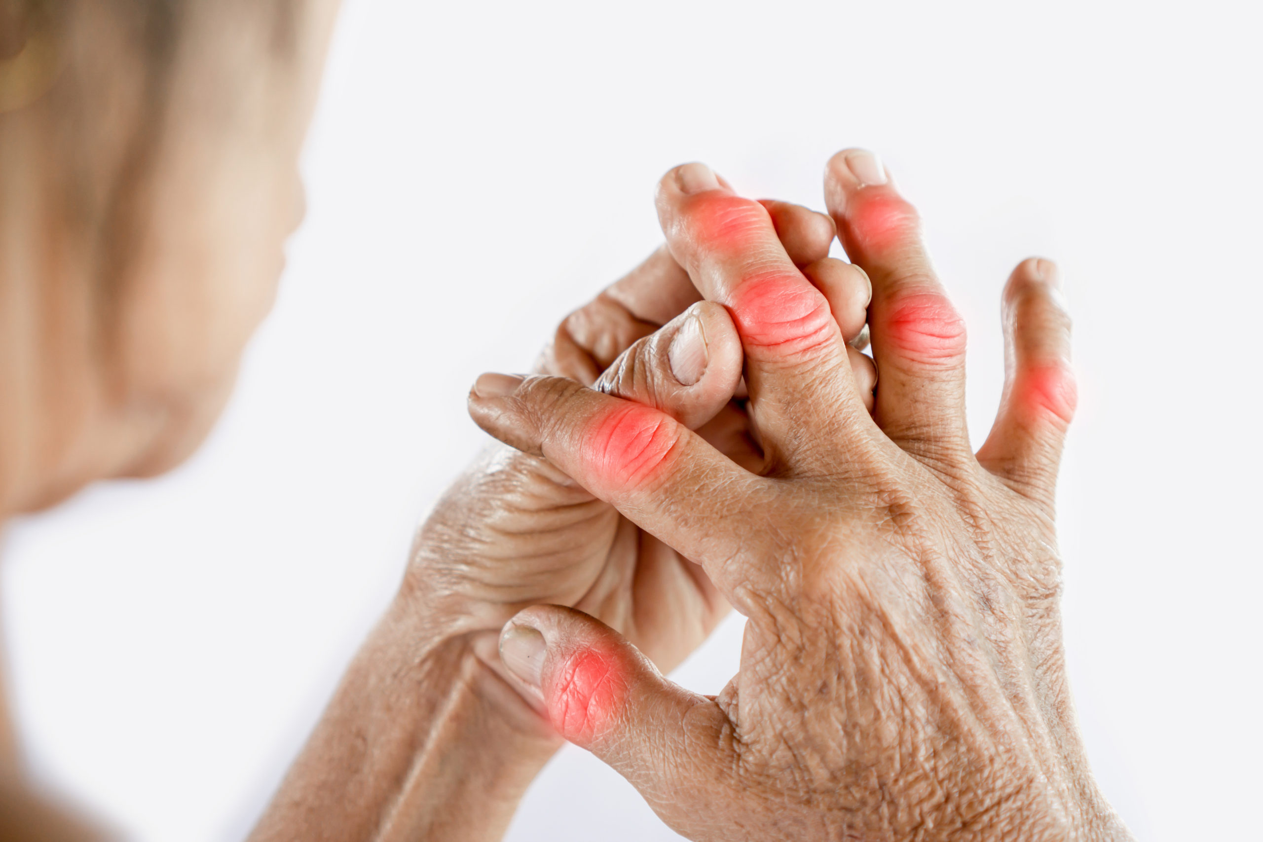 Rheumatoid Arthritis - Woman suffering from joint pain with gout in finger