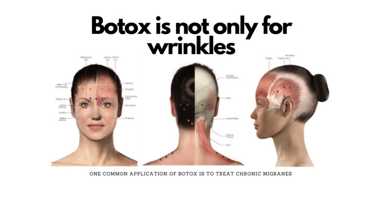 BOTOX® as prophylactic treatment for chronic migraine - A medical image representation