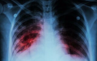 Tuberculosis: Disparities in Indigenous populations (study) - X-ray image of the lungs