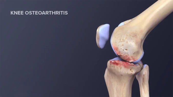 Knee Osteoarthritis Pain - Knee Bone Illustration