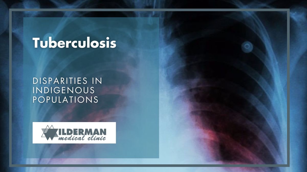 Tuberculosis: Disparities in Indigenous populations