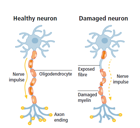 Multiple Sclerosis Present In Different Parts Of The Body