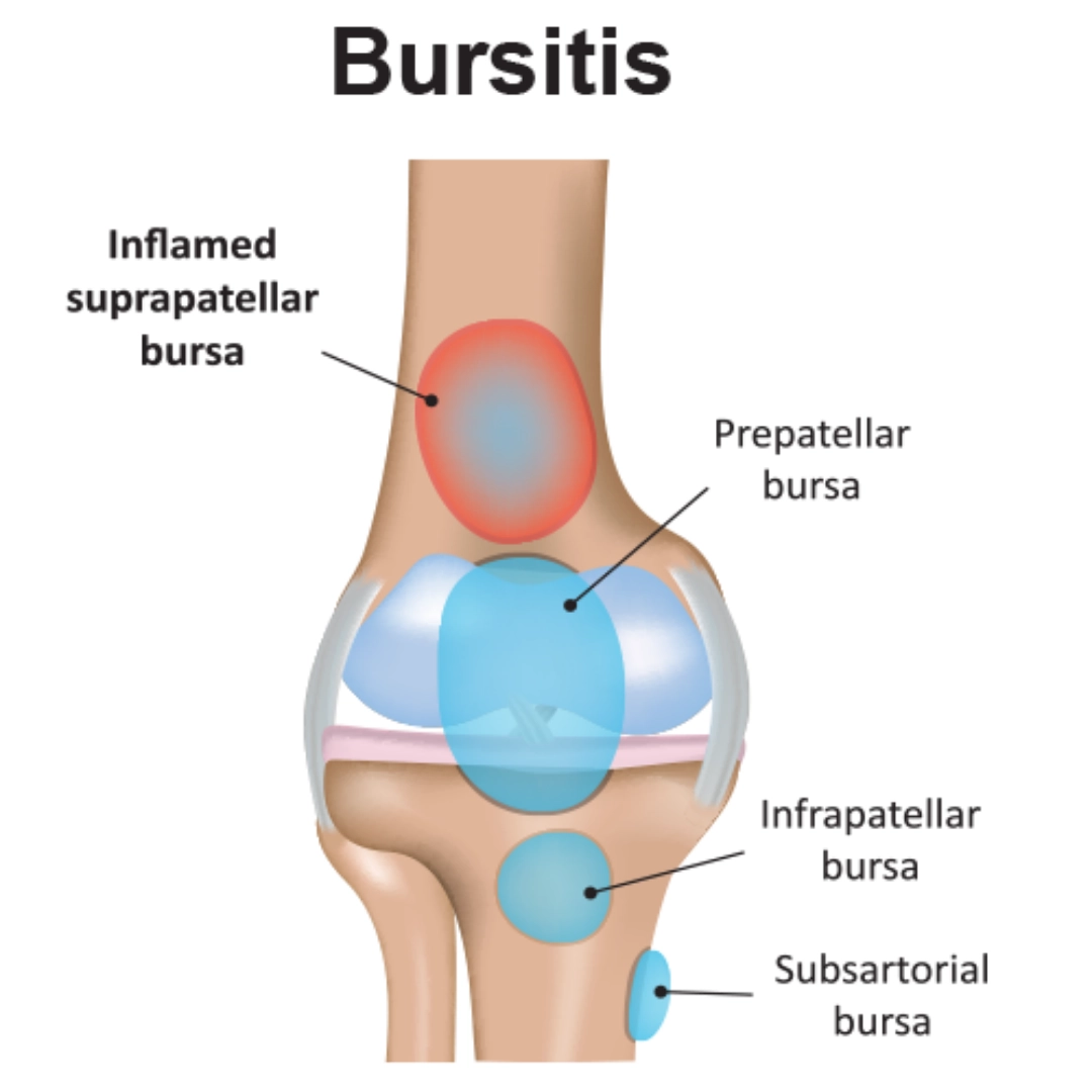 Types of bursitis that may occur - Infographic