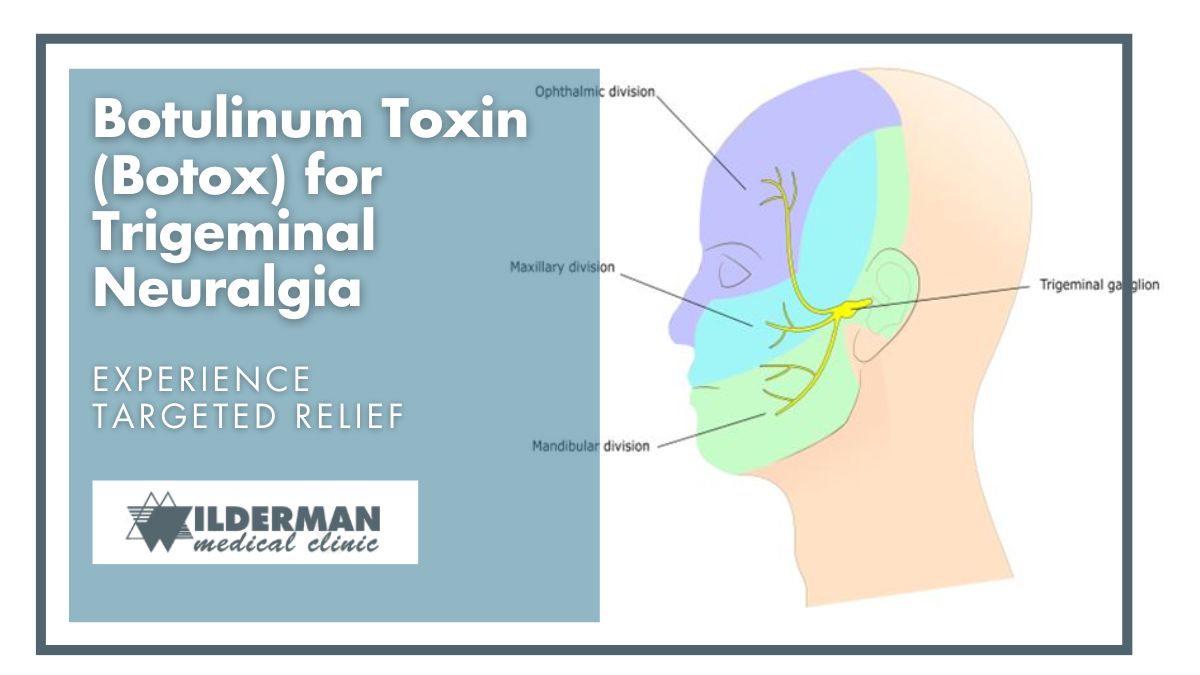 Botulinum Toxin (Botox) for Trigeminal Neuralgia