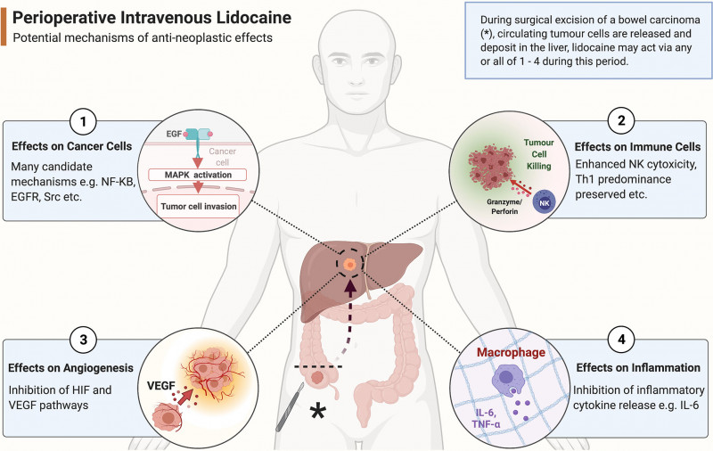 Lidocaine Intravenous Infusion To Minimize Chronic Pain Symptoms