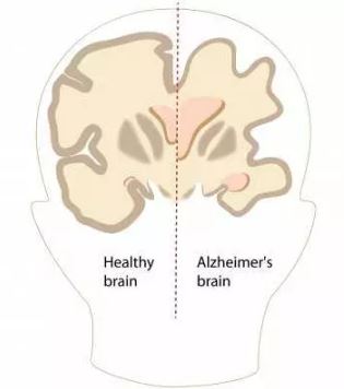 Alzheimer disease brain compared to normal