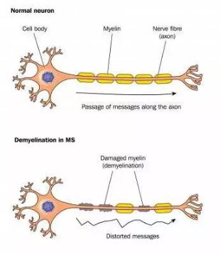 Normal neuron nerve cell and demyelinated neuron in multiple sclerosis