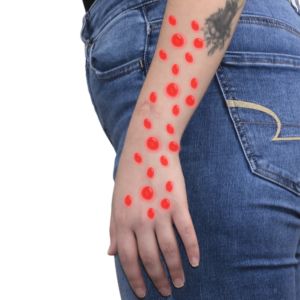 Allergy Clinic - Wilderman Medical Clinic